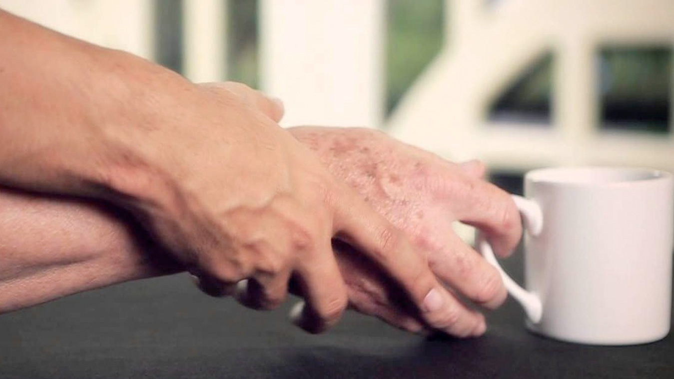 Cirurgia contra parkinson passa a ser realizada pelo SUS